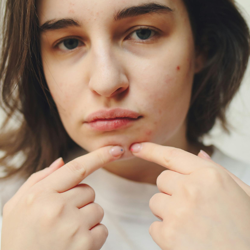 Could Dairy Be Causing Your Acne (and Other Skin Issues)?